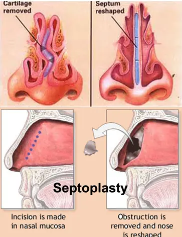 تصاویر جراحی 📌عمل سپتوپلاستی و مراقبت‌‌ها| از نگاه ۱۷ متخصص جراح